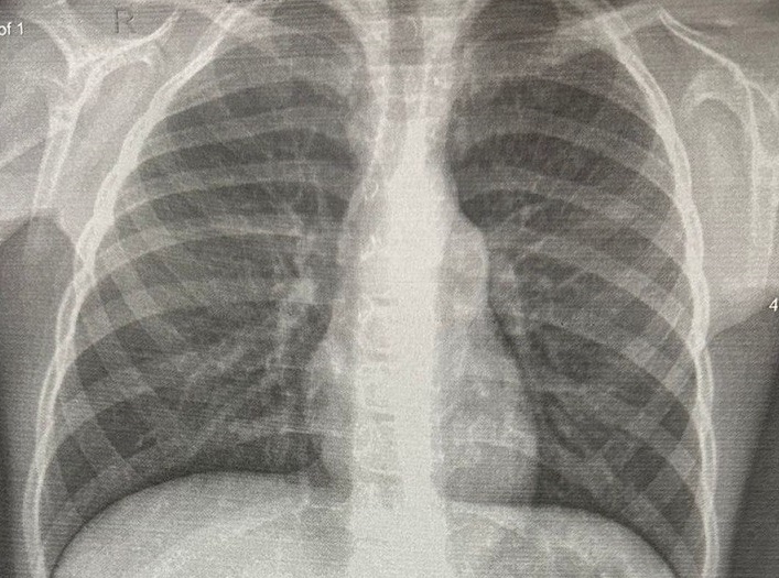 На этой неделе красноярцы могут бесплатно пройти флюорографию